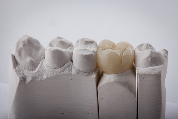 When A Dental Inlay May Be Your Best Restoration Option