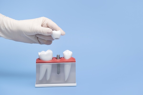 The Recovery Process After Getting Tooth Implants